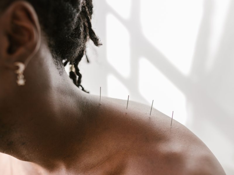 Dry Needling vs. Acupuncture: Understanding the Difference in Pain Relief Woking
